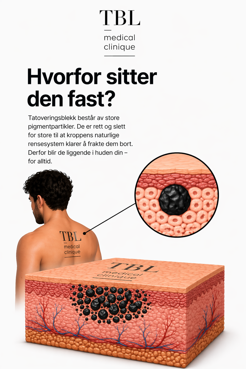 Hvorfor blekket sitter: pigmentpartiklene er for store til at kroppen kan rydde dem selv.