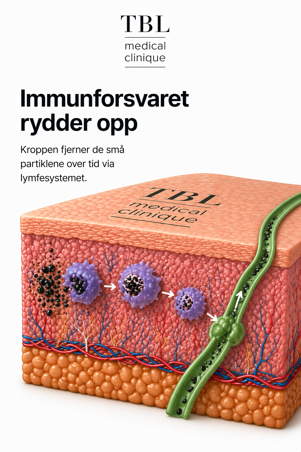 Makrofager og lymfesystemet transporterer bort de knuste pigmentpartiklene.
