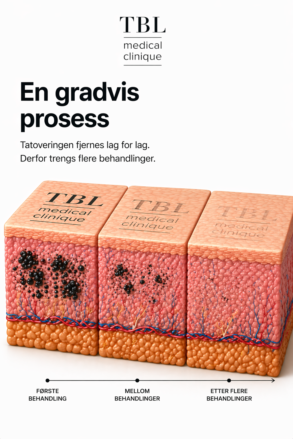 Flere behandlinger med pause mellom — derfor flere måneder fra start til slutt.