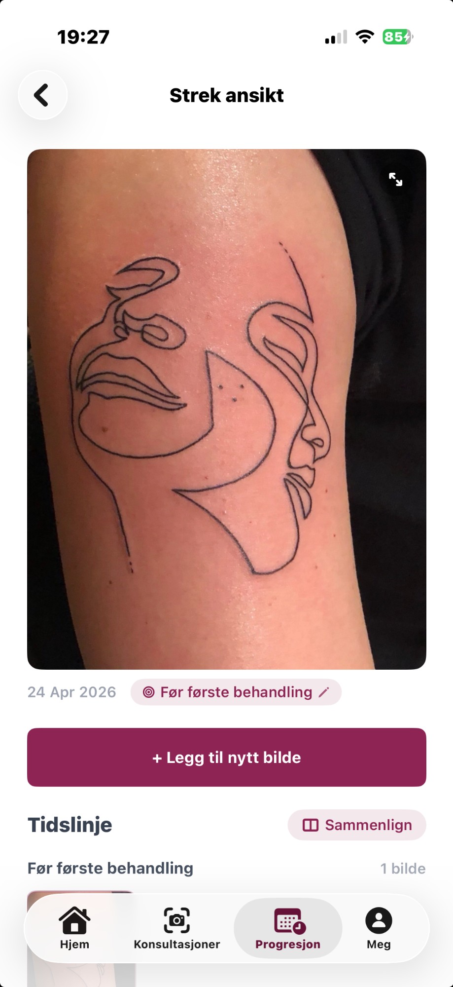 TBL Medical-appen — progresjonslogg som viser før-bilde av tatovering med tidslinje
