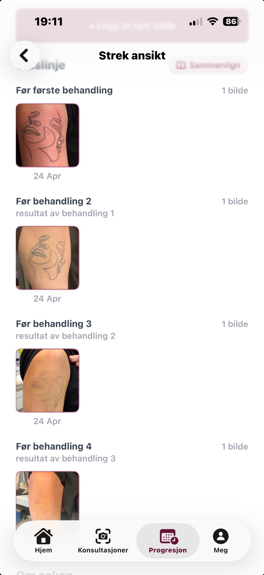 Progresjonslogg — tidslinje med fire behandlinger som viser tatovering bleknes